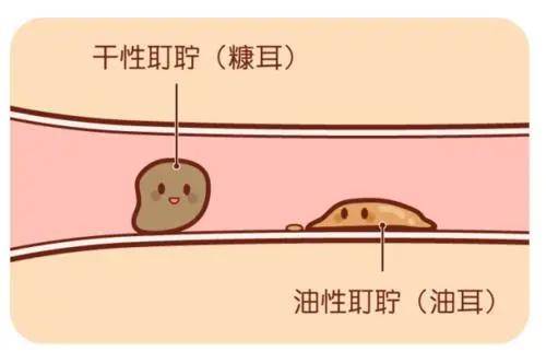 泰兴梦之声助听器油耳朵该怎么办