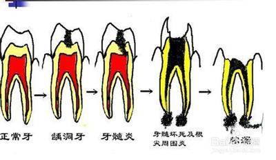 【科普】牙龈癌