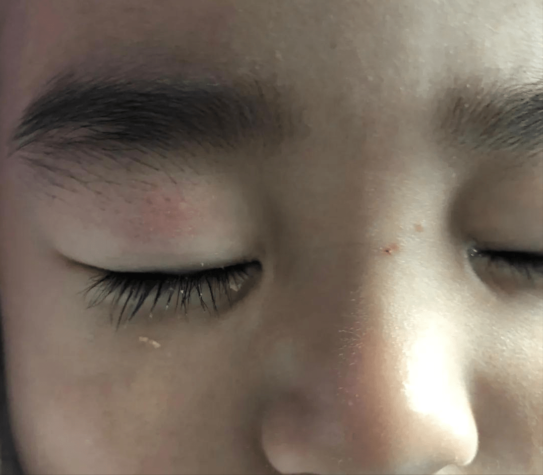 或者眼屎增多;那就说明是眼睛是出问题了,可能是结膜炎和脓漏眼,一般