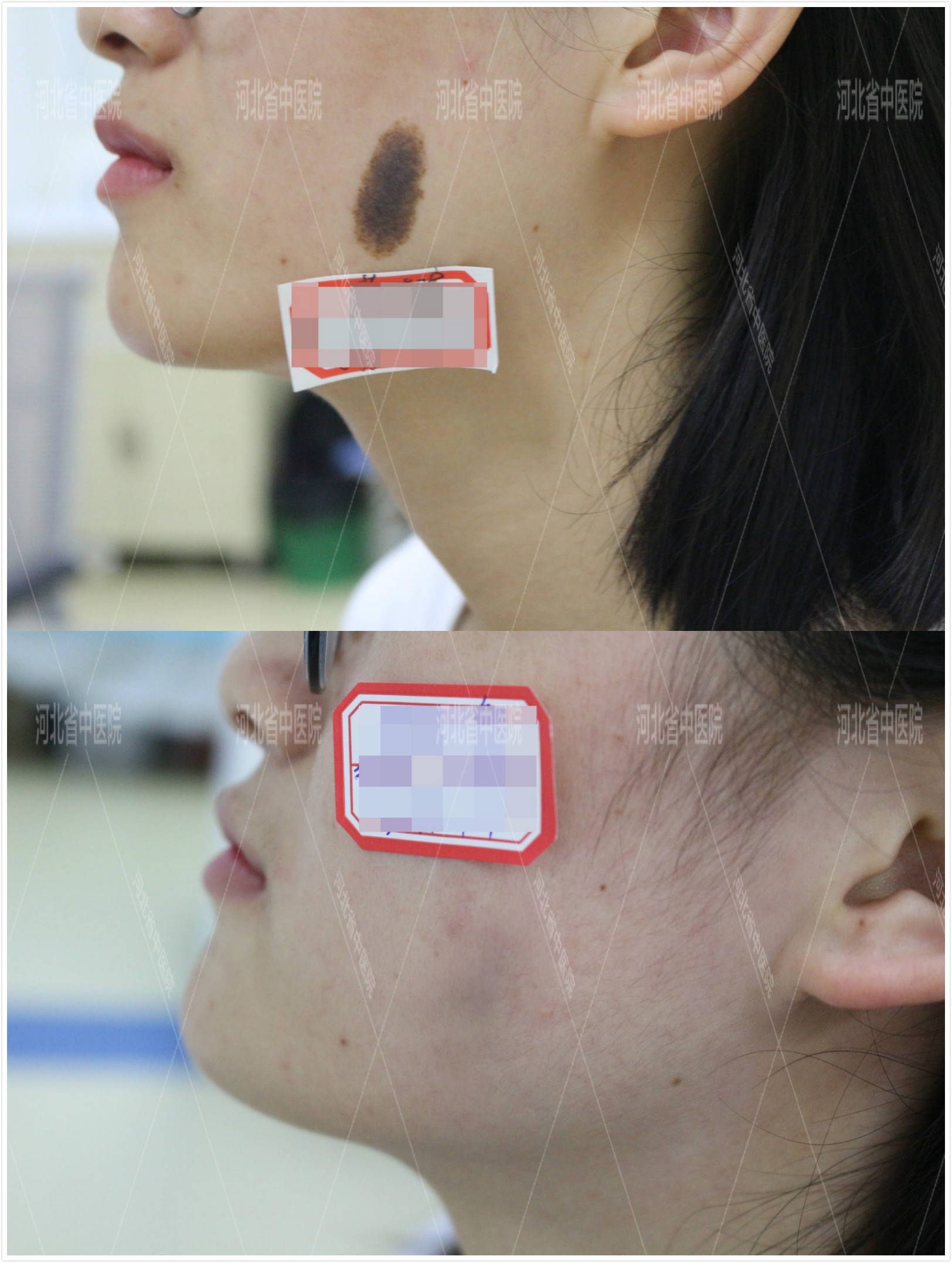 河北省中医院医疗美容赵士红主任解析:哪些黑毛痣会恶变?_手机搜狐网