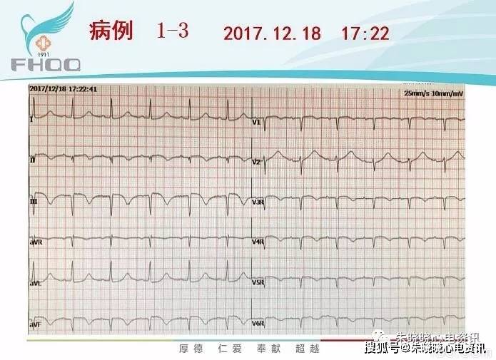 心肌缺血的心电图表现_后壁