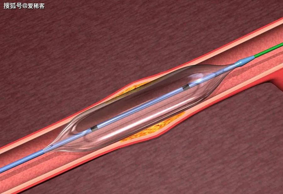 球囊扩张术血管图片