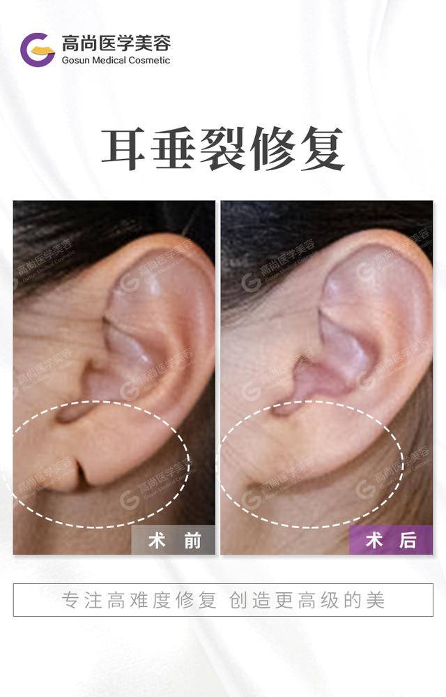 耳垂畸形修复术后耳朵会留疤吗?