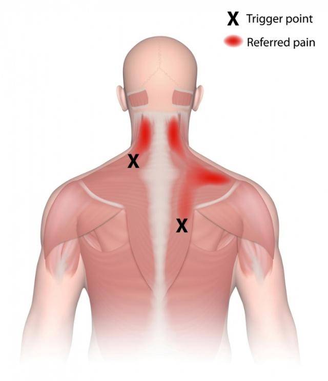 胸背肌筋膜炎的症状图图片