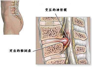 腰间盘突出在哪个位置图片