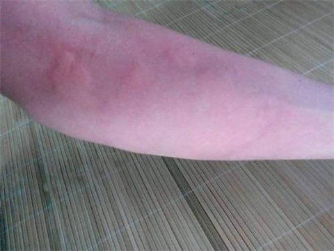 原创对水过敏的女孩,不敢出汗不敢流泪,就连洗澡都可能要了她的命