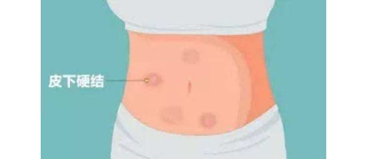 肝素大肚子的位置图图片
