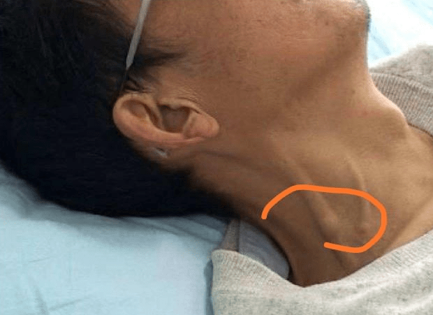 读者来信:"颈动脉斑块"会不会堵住脑子?答案竟然是