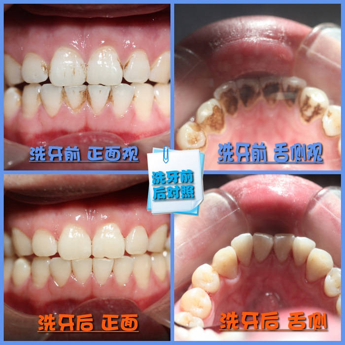 遇到冷热酸甜会牙齿酸软,这叫做牙本质敏感,是洗牙以后常见的一种症状