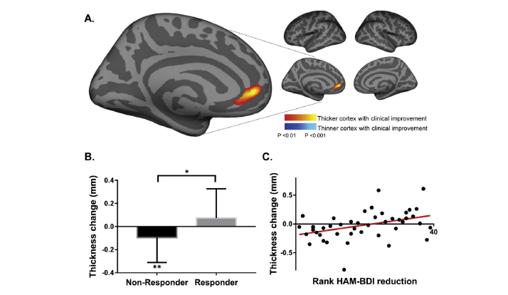 延髓前扣带回皮层是rtms治疗抑郁症过程中的相关结构