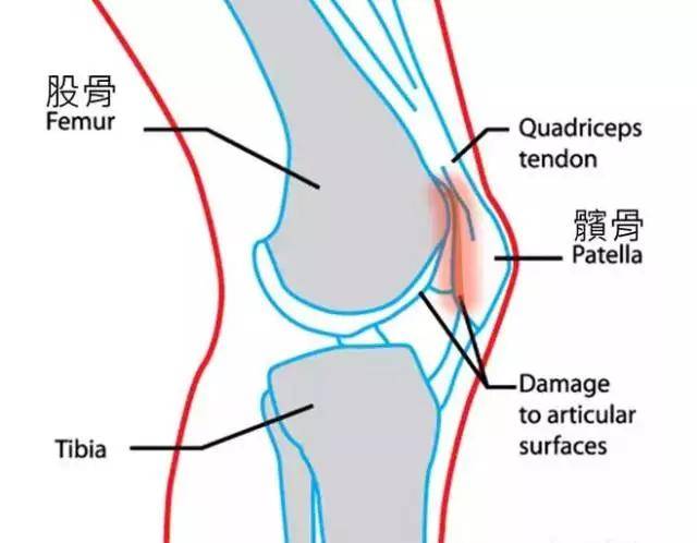 膝关节各种疼痛及不同病因教你如何预防及锻炼恢复