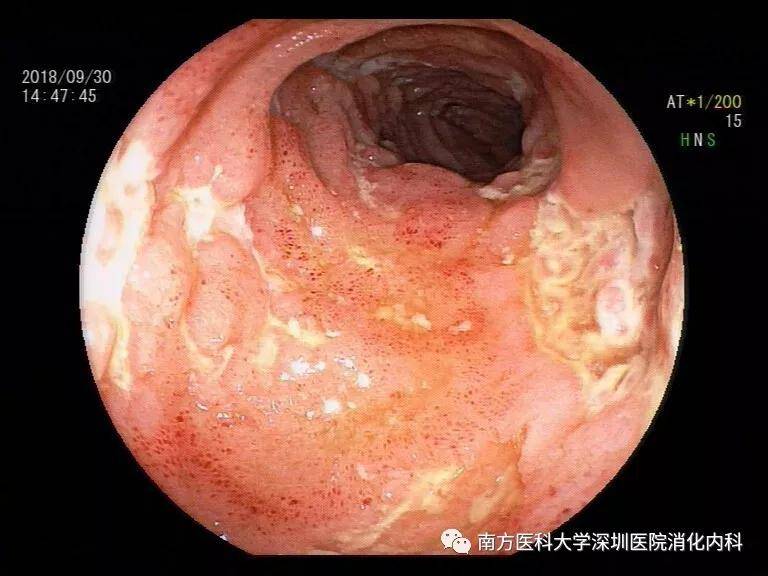 当时消化内科王芳主任告之他诊断为"克罗恩病,需要住院治疗.