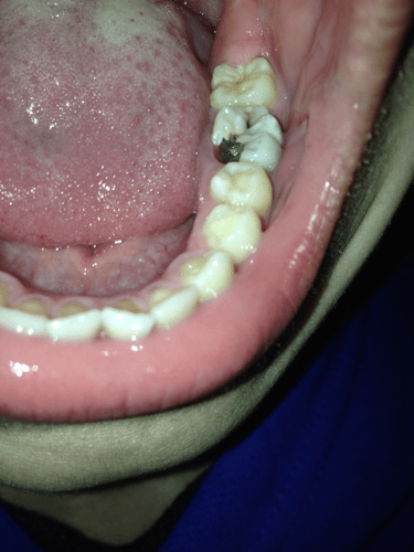 牙齿烂了一半去医院补牙遭医生拒绝