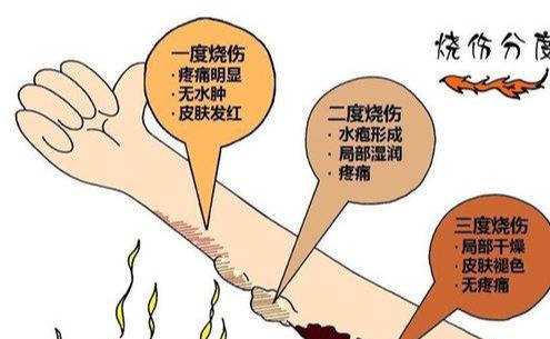 被热水袋烫红怎么办