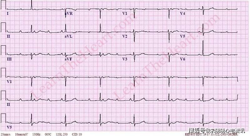 警惕这4大心电图危急值,生死一线!
