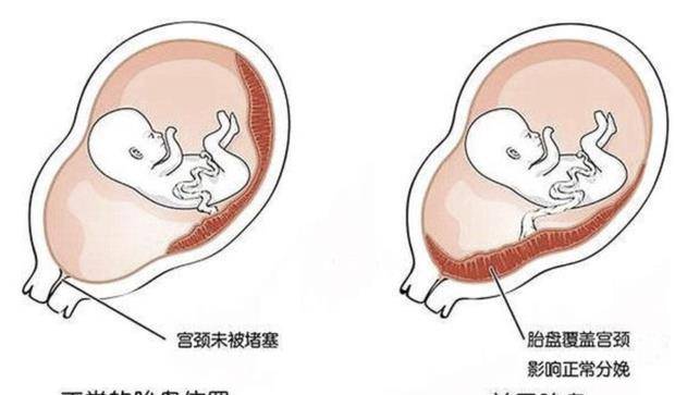 孕妇几个月开始显怀呢过早显怀一般有这3种原因你中了吗