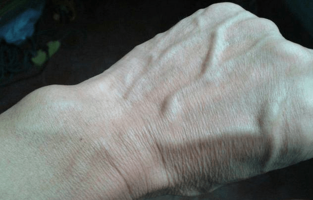 肝脏有癌,手上可能有3个"信号",快瞧瞧你有没有中招