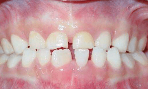 宝宝牙齿矫正的3个黄金期,别错过!