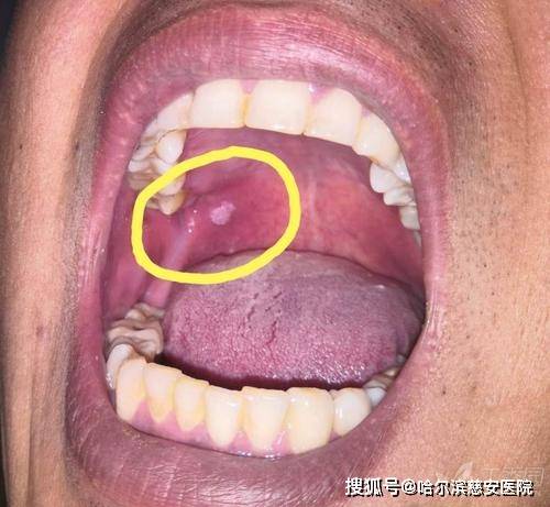 口腔颊粘膜增生图片