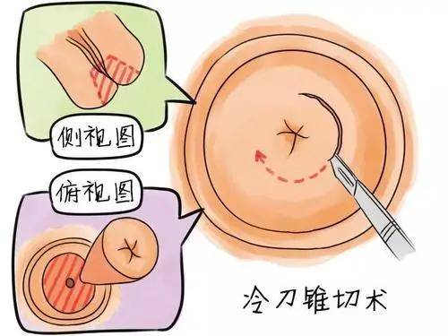 目前常用的锥切术式包括:宫颈冷刀锥切术(ckc),宫颈环形电切术(leep).