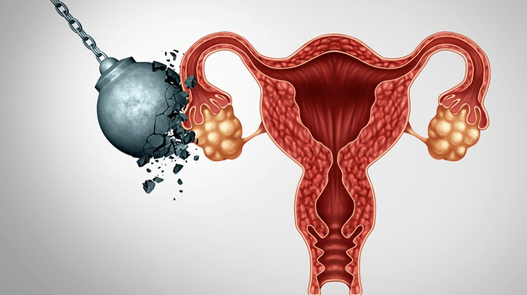 就有可能是生殖细胞恶性肿瘤了。且很可能我们日常生活中常说的卵巢癌。