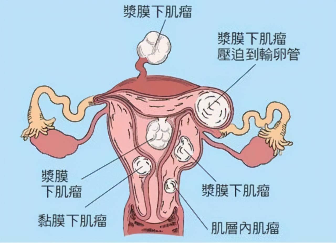 名医访谈子宫肌瘤那些事儿