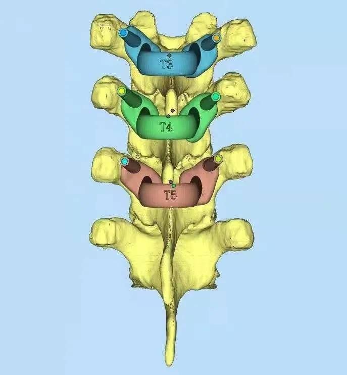 脊柱|外科医生有妙招 3D打印模型模拟手术减风险