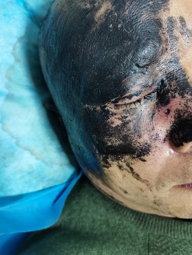 六旬男四个心脏支架手术后突患带状疱疹 疼得满地打滚 直言这病把我