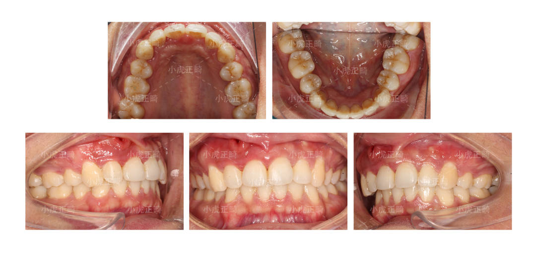 這時會分別給你拍一張正面牙齒咬合照,和兩張側面牙齒咬合照片.