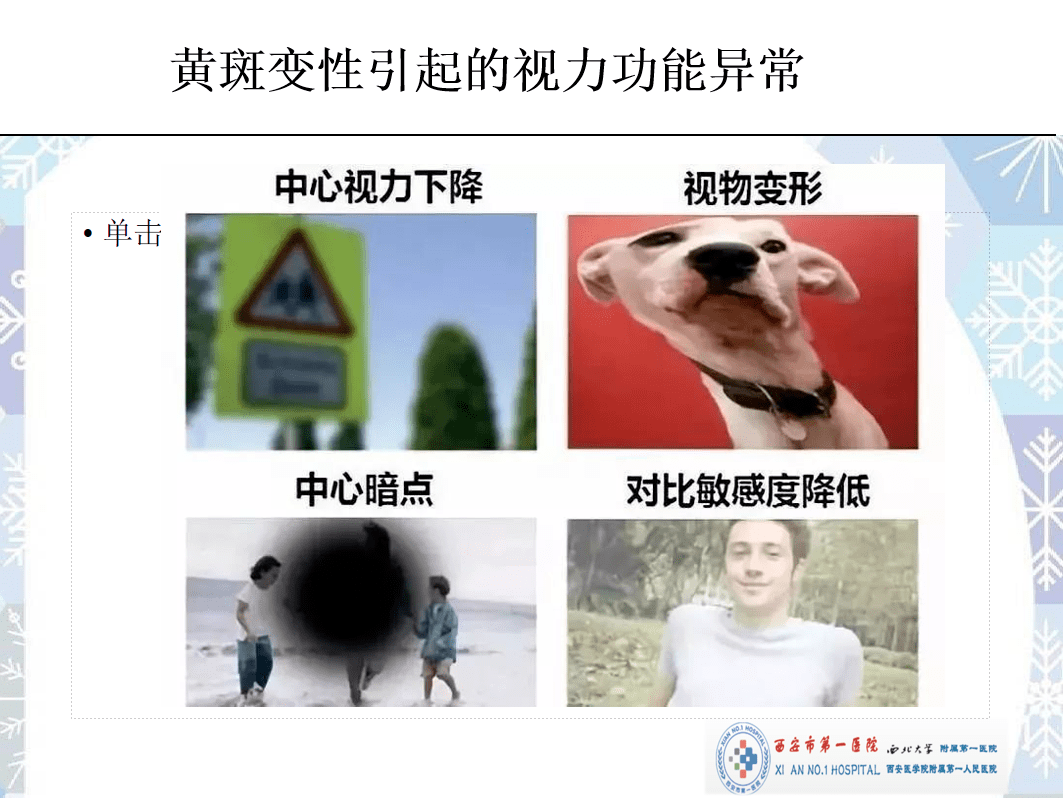 老年性(年龄相关性)黄斑变性