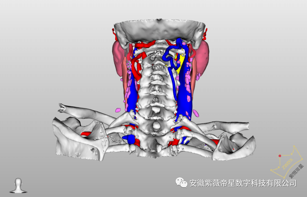 綿陽市三醫院甲狀腺頭頸頜面外科運用3d技術精準定位切除咽旁腫瘤