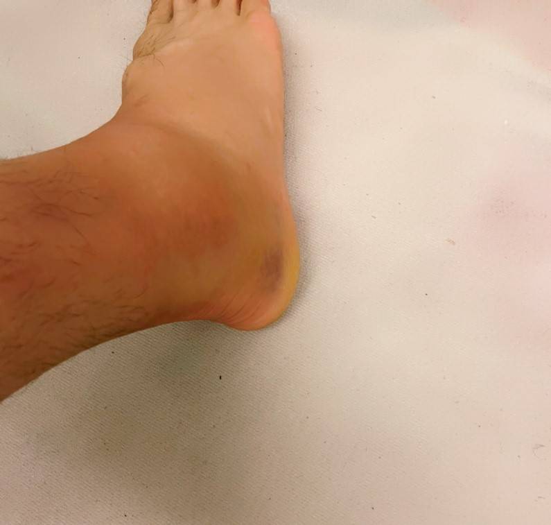 原创赵继伟伤脚依旧肿胀青紫高诗岩打趣被怼周琦晒图被键盘侠奚落