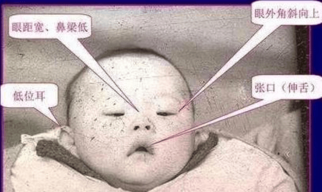 患有唐氏综合征的宝宝,面部特征很明显,婴儿阶段就能看出来