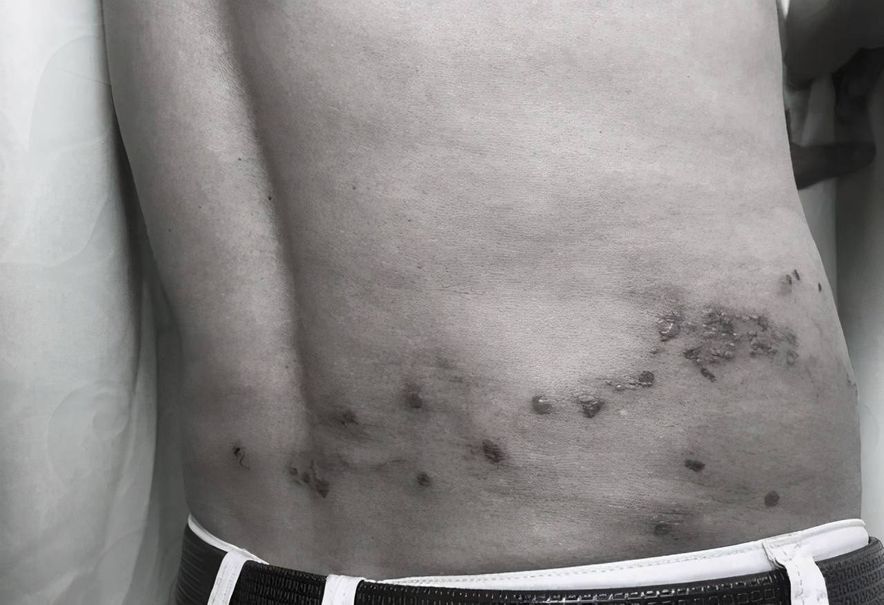 大妈被"蛇缠腰",在身上画"符"镇蛇?医生:拒绝迷信