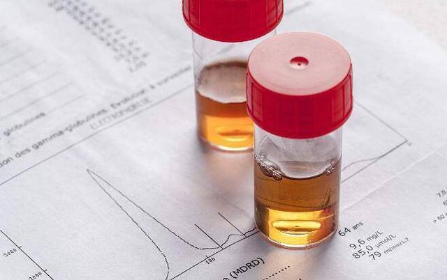 疑惑:同样是尿蛋白,为什么别人的很快就转阴,自己却迟迟见不到疗效?