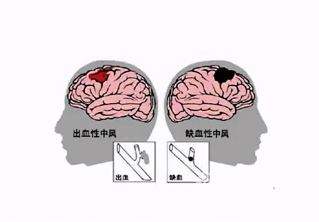 腦出血是腦內的血管破裂出血;腦梗死是腦內的血管堵塞缺血.