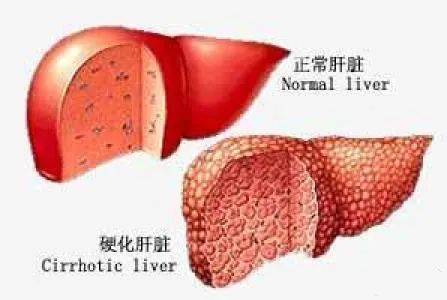 肝硬化