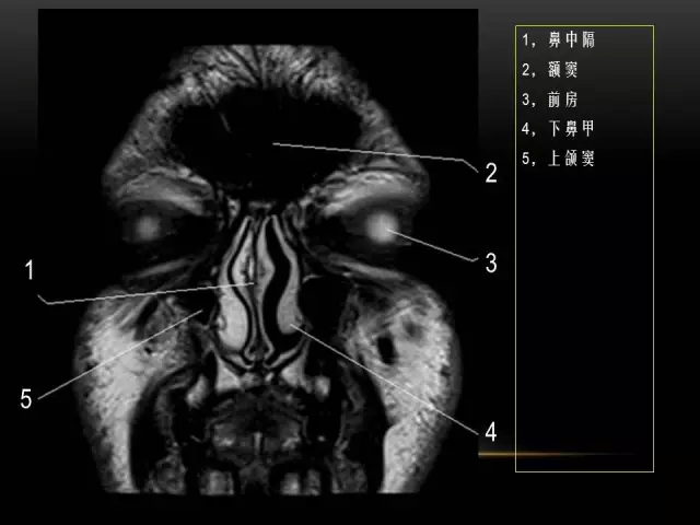 mri下眼部及鼻竇解剖圖譜_平臺