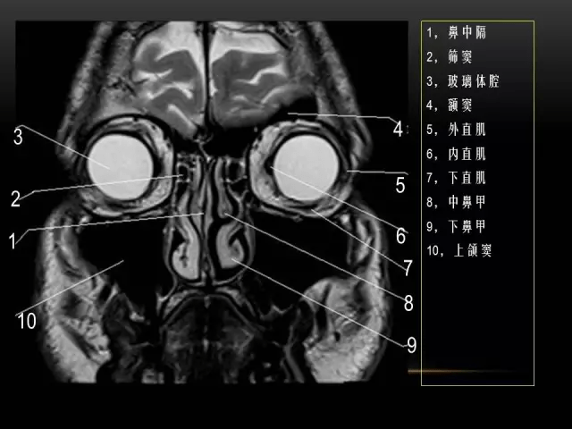 mri下眼部及鼻竇解剖圖譜