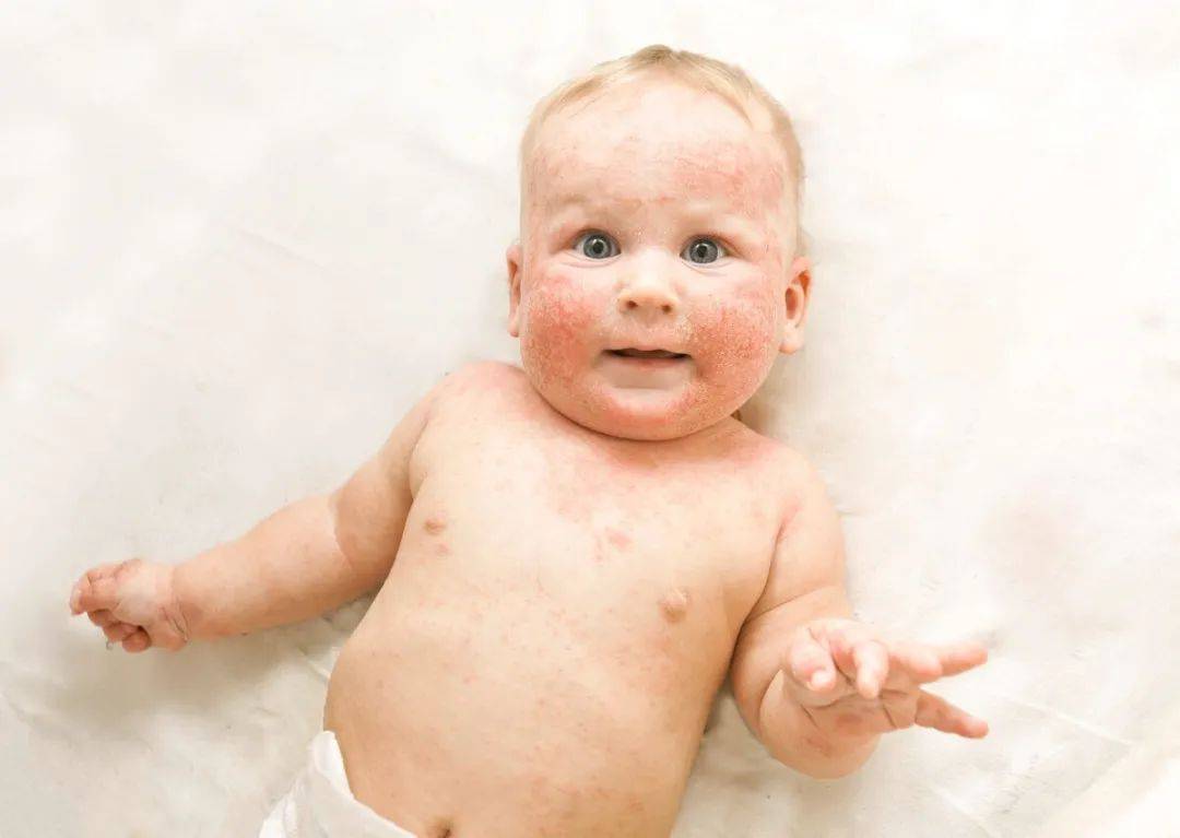 宝宝湿疹有哪几个特征？该怎么办？
