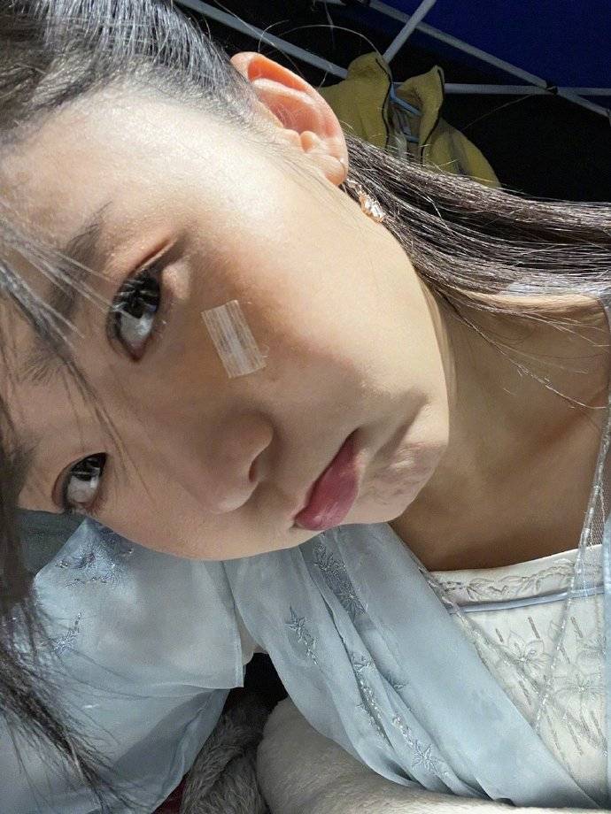 照片中看到宋伊人拍的她脸上的洞,还有血呢,这个洞看着都疼,就怕以后