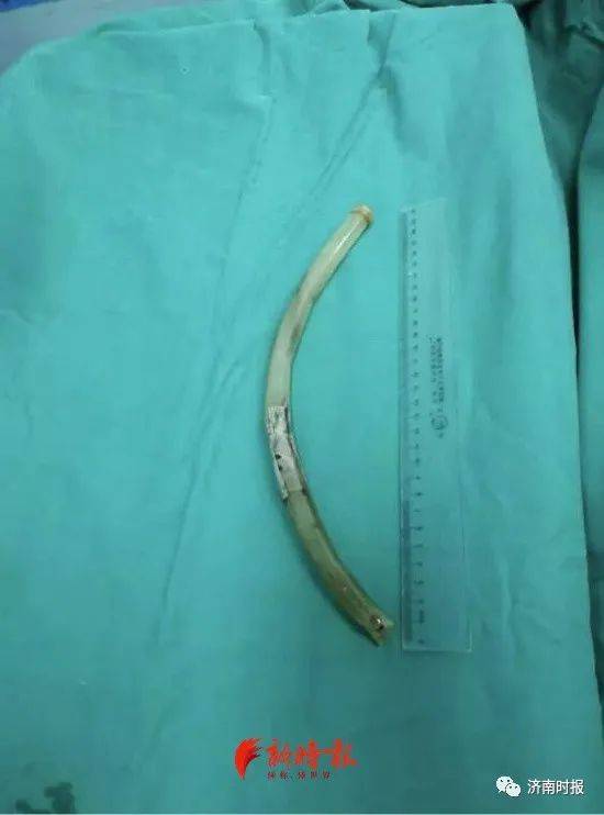 仙女管还是夺命管济南医生重要提醒