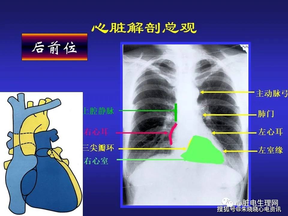 心脏电生理介入治疗相关解剖影像学
