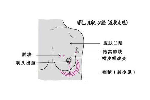 乳房外侧边缘按压痛图片