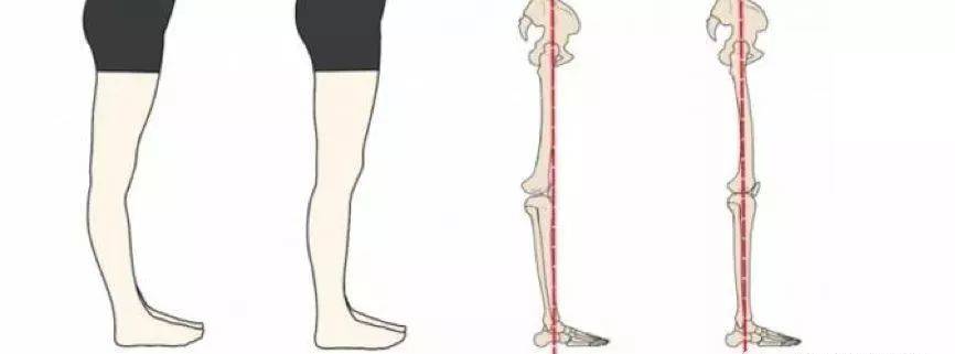 脑卒中康复训练不要忽视"膝过伸"_膝关节