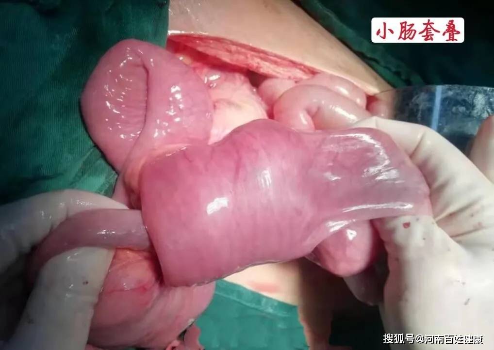 是什么原因引起胃里长息肉 b711bb5c01034f1cb119cd8490cf1bb8.jpeg