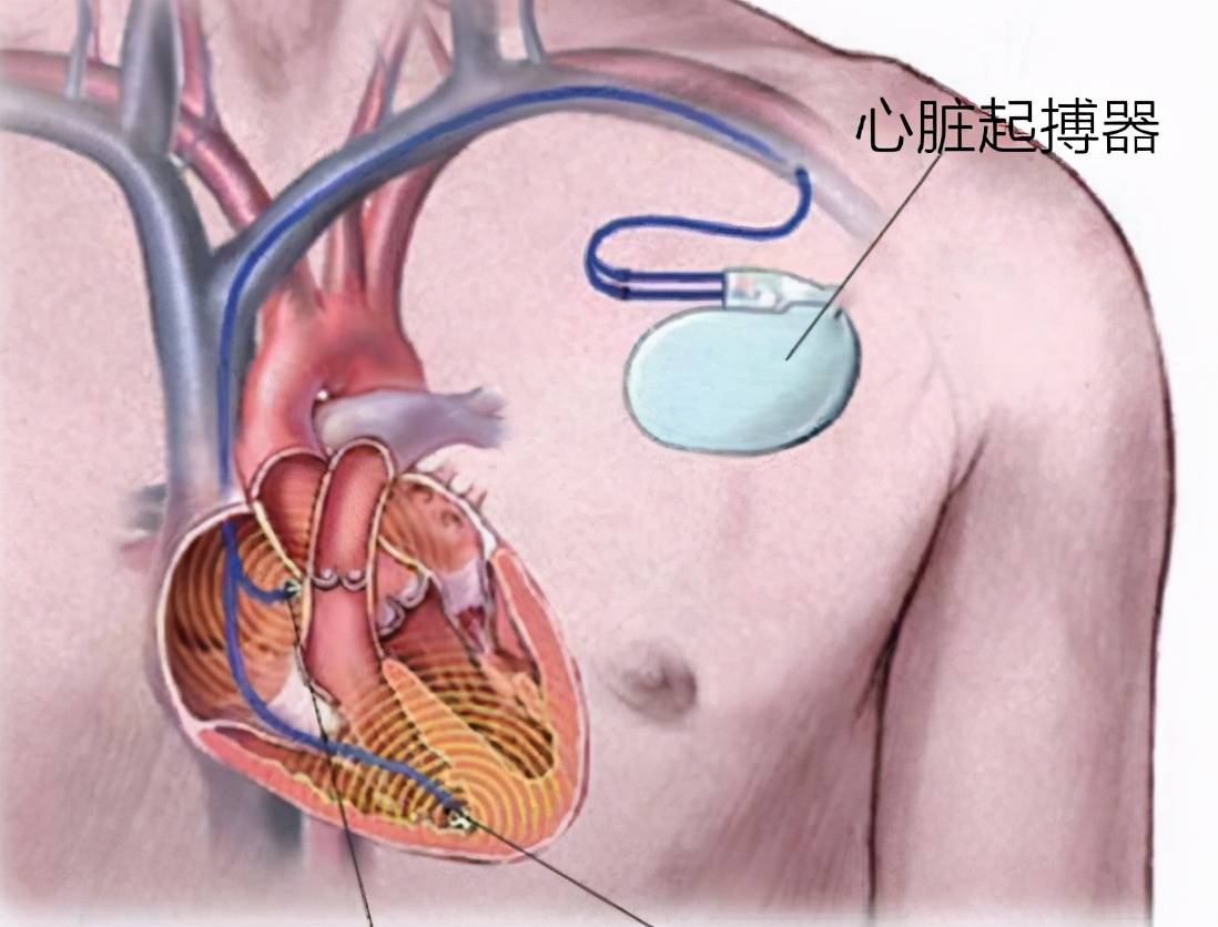 心动过缓患者你了解心脏起搏器吗