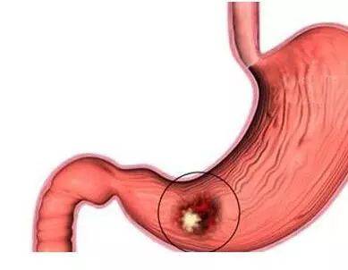 胃溃疡常见症状有这些，来看看你是否需要就医！
