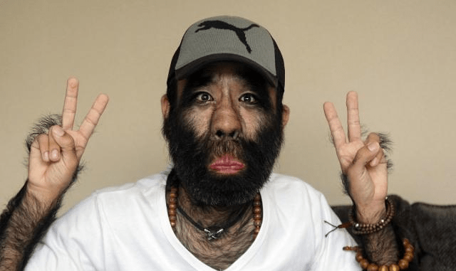 什么叫做无毛症 be3165bf298b49d1ac56c8fd0e532b8d.png