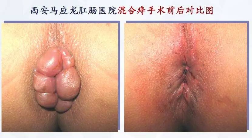 马应龙|西安治疗痔疮哪家医院比较好